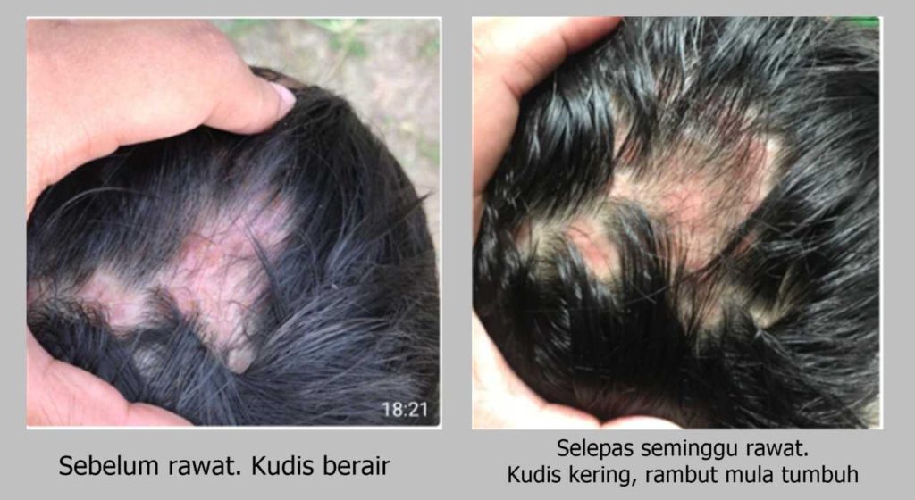 kudis berair didapati kering selepas seminggu sahaja guna krim S3