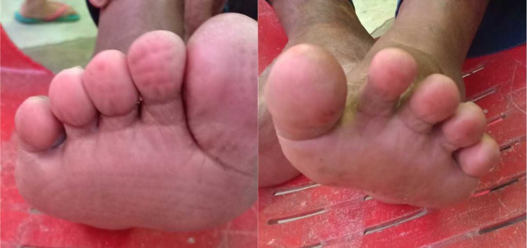 Kulat air yang menyebabkan gatal celah jari di kedua-dua belah kaki telah sembuh