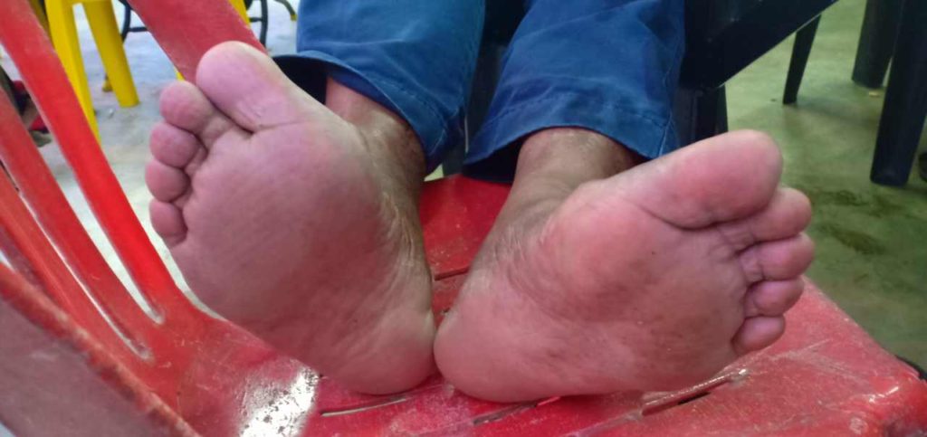 Tiada lagi kulat air yang menyebabkan gatal celah jari kaki selepas diletak ubat PS Herbs