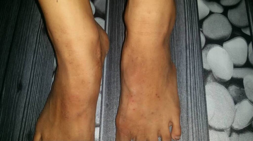 Penyakt Kudis buta boleh sembuh hanya dalam masa 4 hari. Penyakt Kudis buta boleh sembuh hanya dalam masa 4 hari.