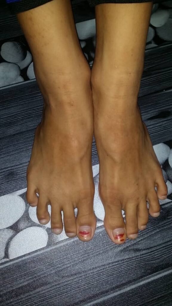 Penyakit kudis buta keluarga Nor ayu - kudis pada kaki sembuhskabies pada kaki