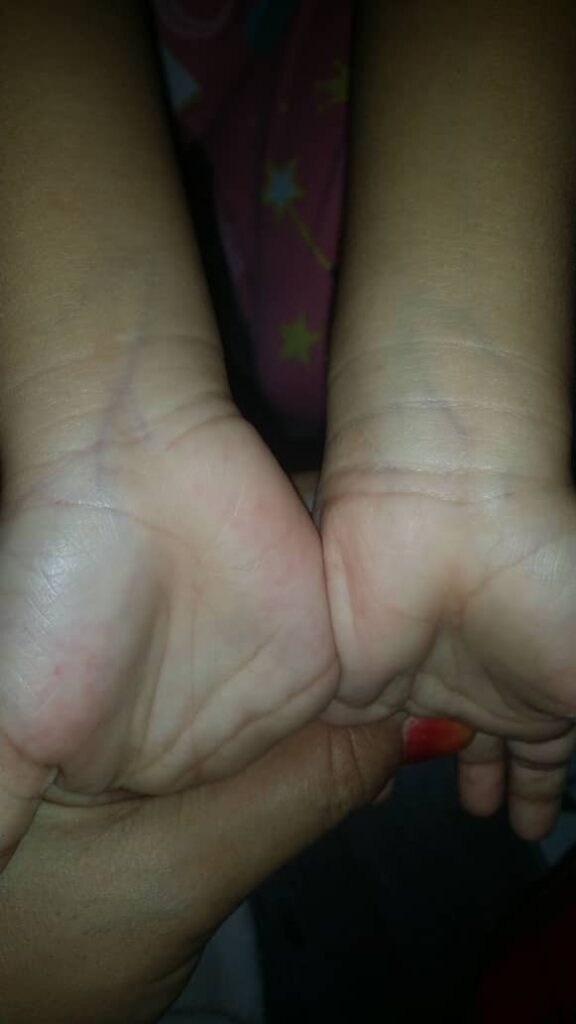 Tangan kudis buta keluarga Nor Ayu jadi licin selepas dirawat dengan Spray F7