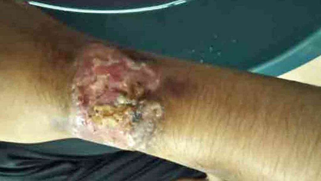 Kudis sporo pada pergelangan tangan sebelum dirawat dengn ubat PS Herbs