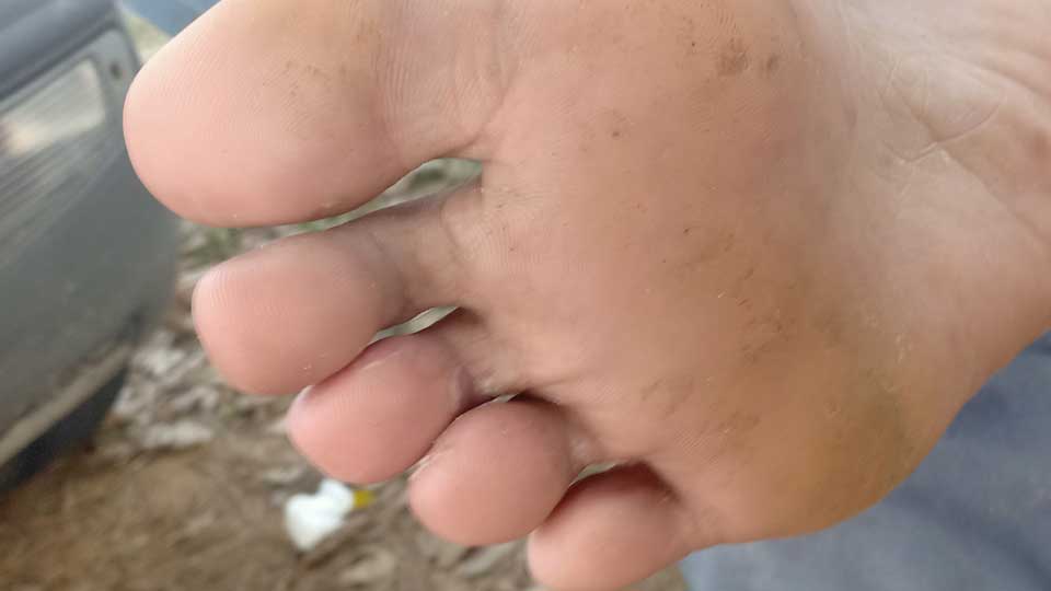 kulat air jari kaki wan sembuh selepas seminggu rawatan