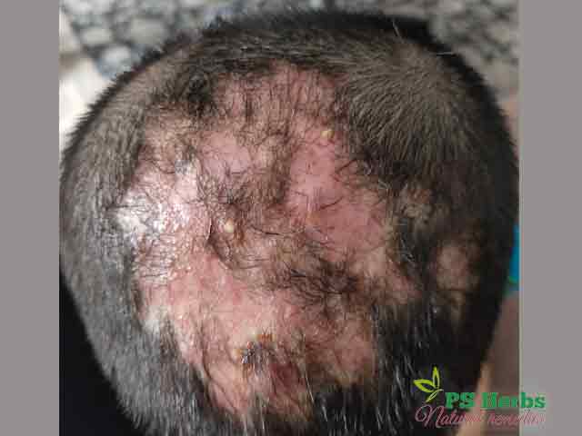 Jangkitan fungus Sporotrichosis di kepala