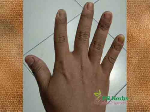 jari Kak Siti sembuh sepenuhnya setelah rawat dengan ubat PS Herbs
