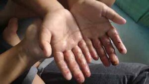 tangan-eczema-anak-nurul