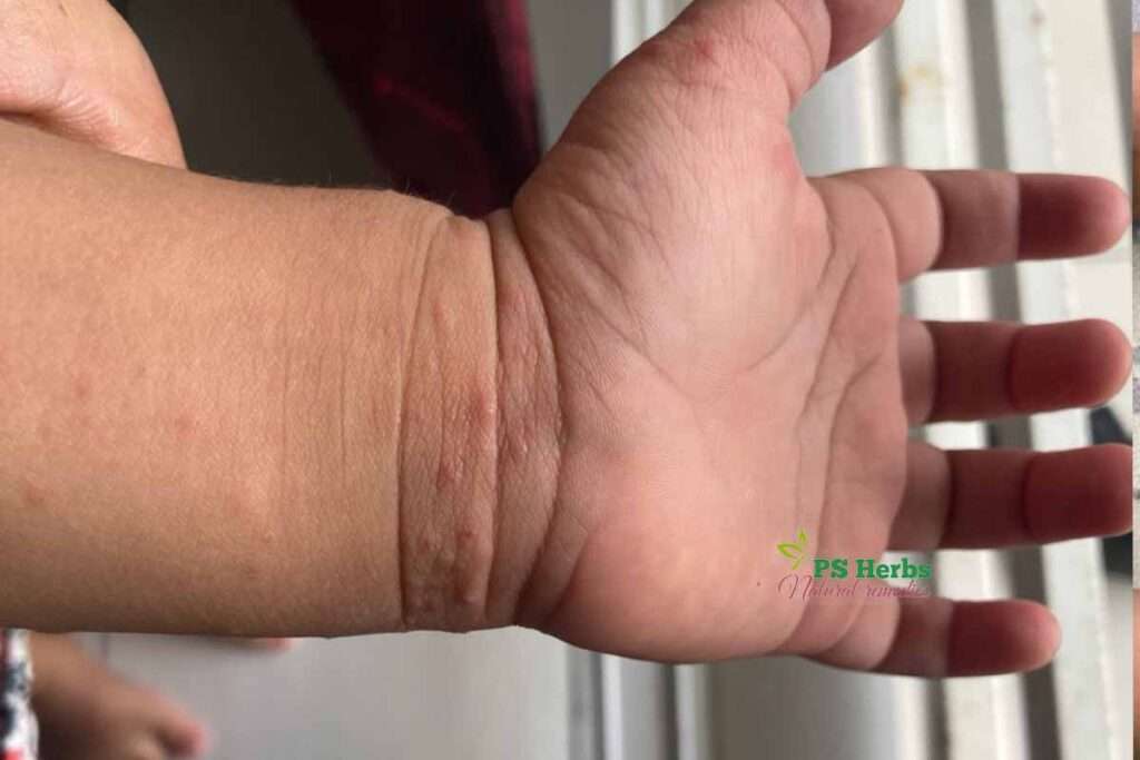 penyakit kudis buta dipergelangan tangan