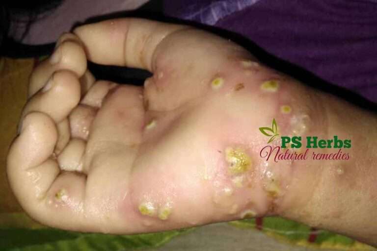 Penyakit kudis buta yang telah ada infection bakteria - berkudis dan bernanah