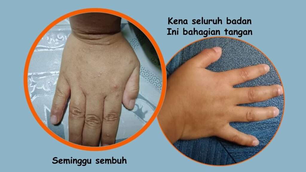 kudis buta anak Jamilah telah sembuh sepenuhnya